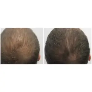 Mocne zdrowe włosy PRO HAIR FORTE