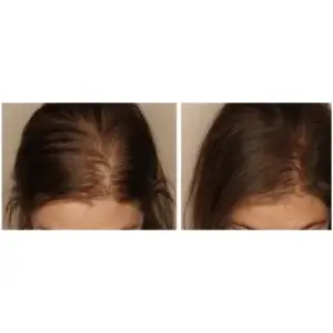 Zdrowe Gęste Włosy PRO HAIR FORTE